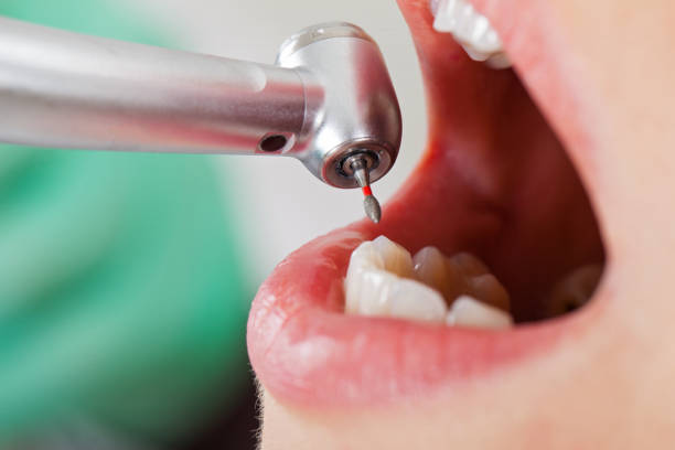 Best Emergency Root Canal Treatment in Perrysburg, OH
